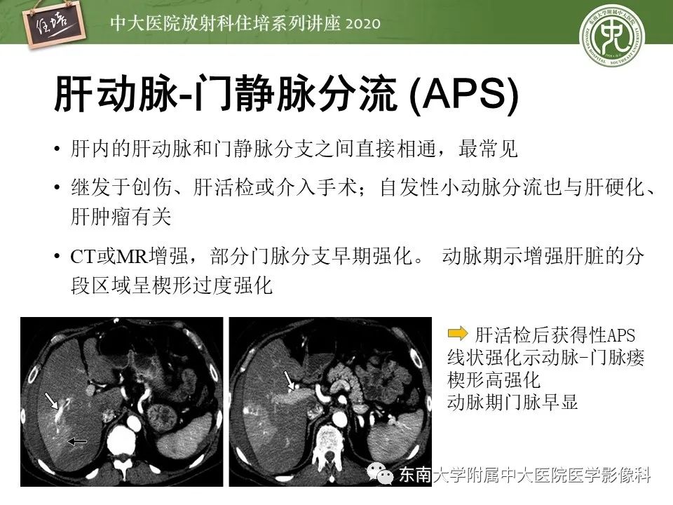 影像PPT - 【PPT】肝脏常见影像征象解读-48