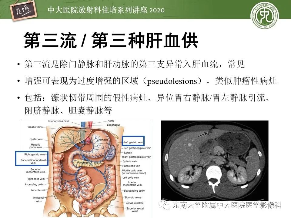 影像PPT - 【PPT】肝脏常见影像征象解读-49