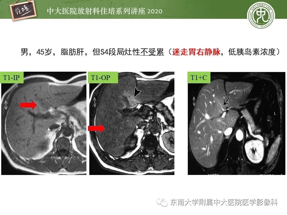 影像PPT - 【PPT】肝脏常见影像征象解读-50