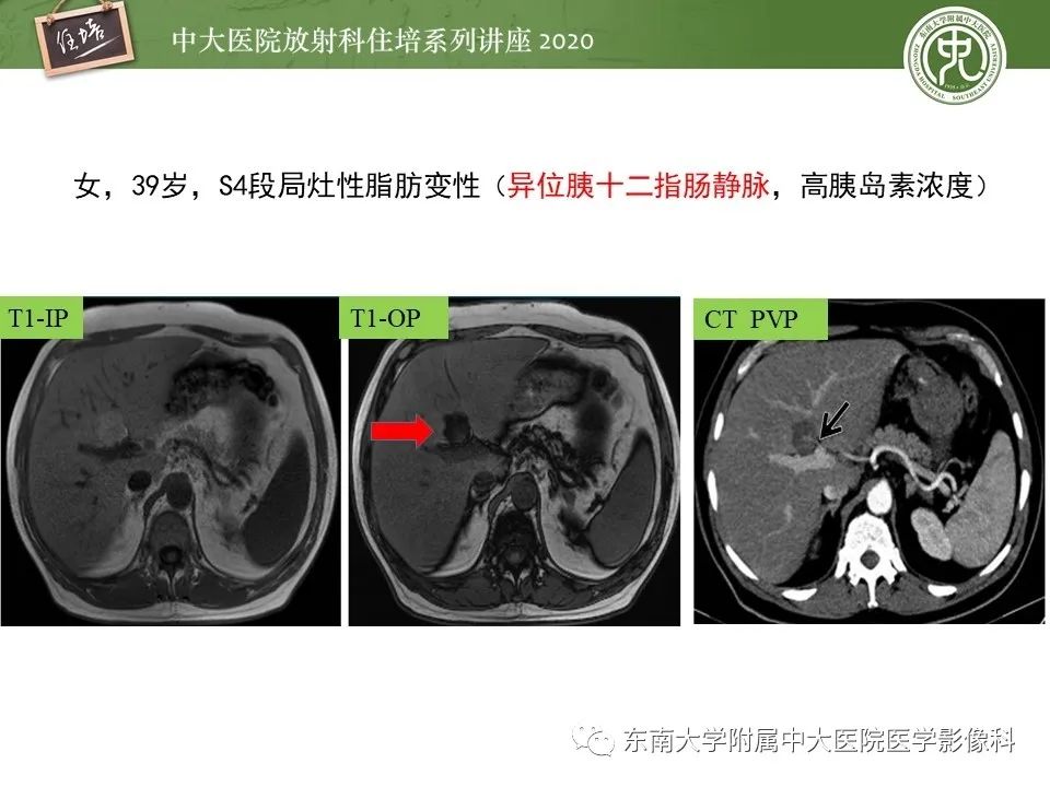 影像PPT - 【PPT】肝脏常见影像征象解读-52