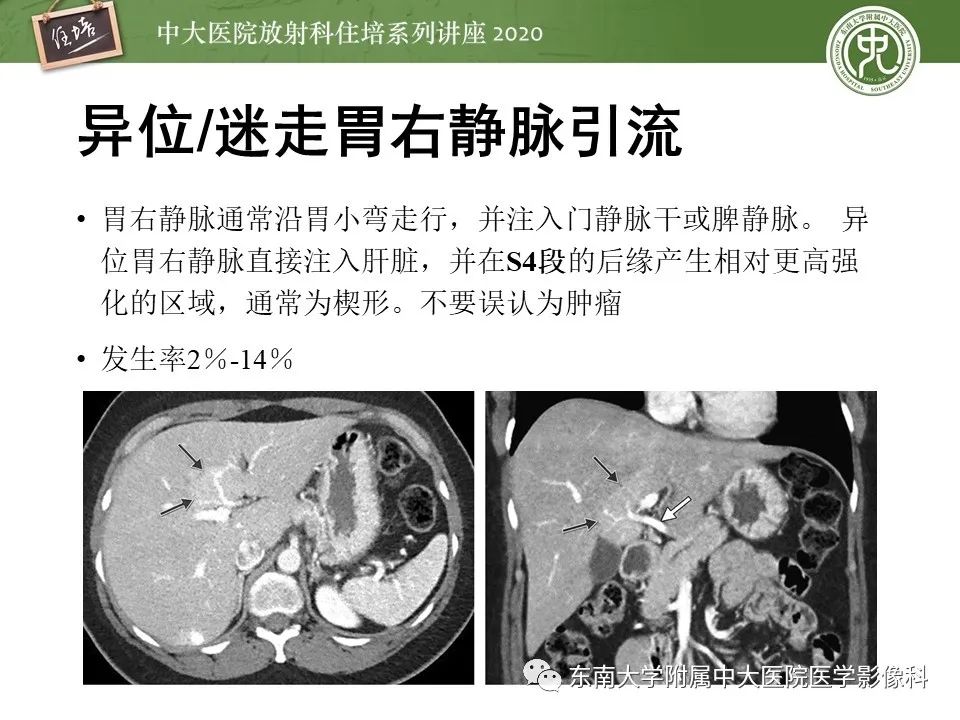 影像PPT - 【PPT】肝脏常见影像征象解读-51
