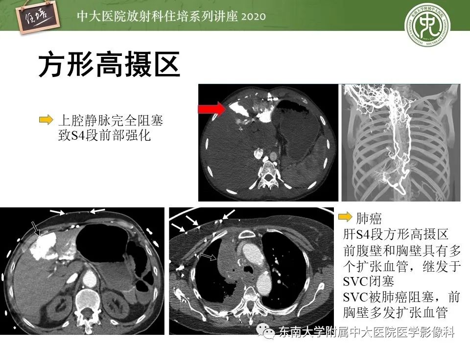 影像PPT - 【PPT】肝脏常见影像征象解读-55