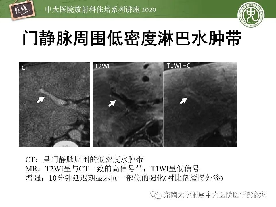 影像PPT - 【PPT】肝脏常见影像征象解读-56