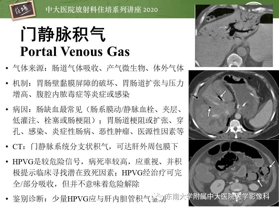 影像PPT - 【PPT】肝脏常见影像征象解读-57