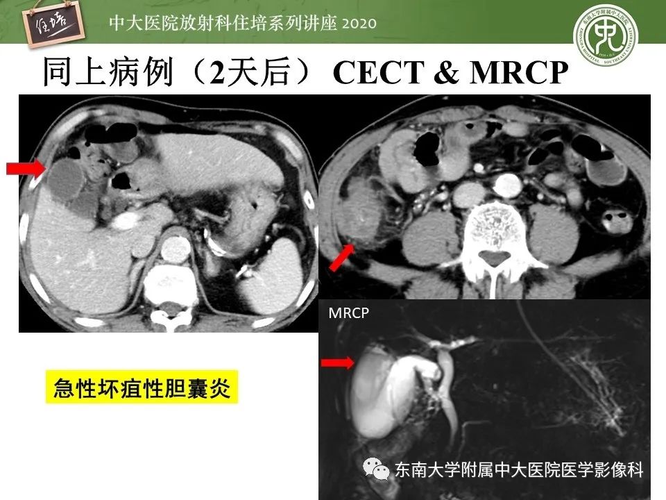 影像PPT - 【PPT】肝脏常见影像征象解读-59