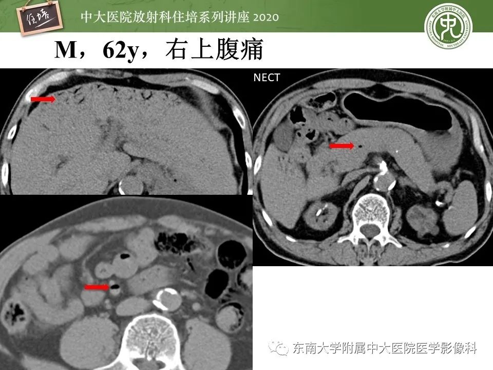 影像PPT - 【PPT】肝脏常见影像征象解读-58