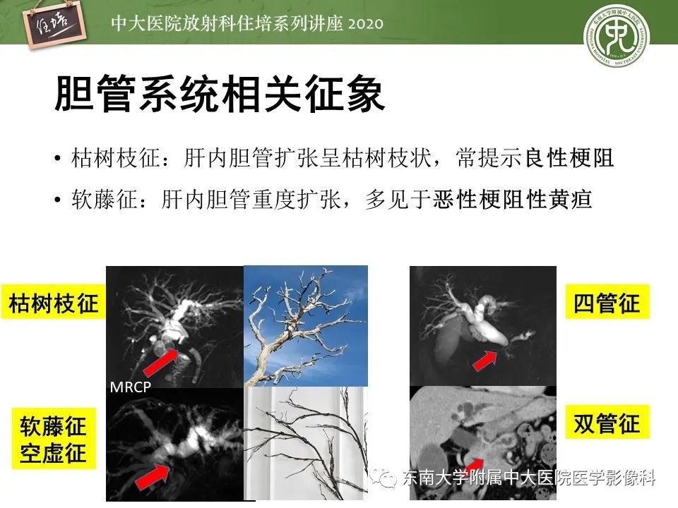 影像PPT - 【PPT】肝脏常见影像征象解读-61