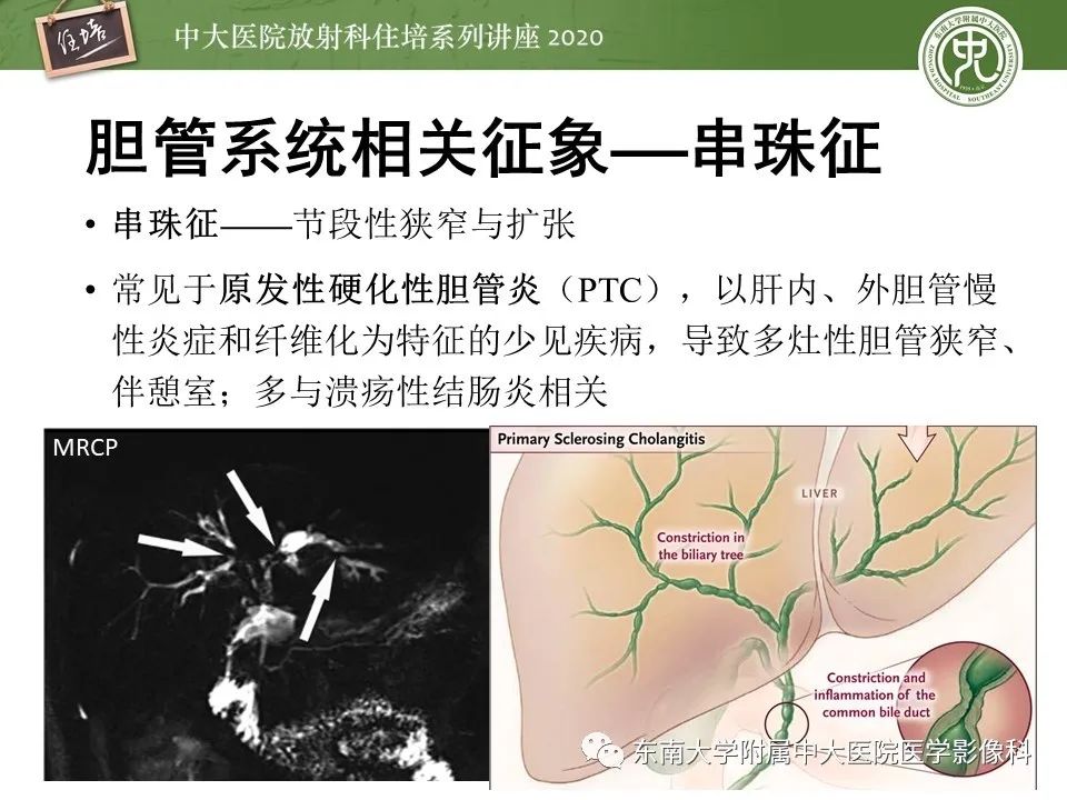 影像PPT - 【PPT】肝脏常见影像征象解读-62