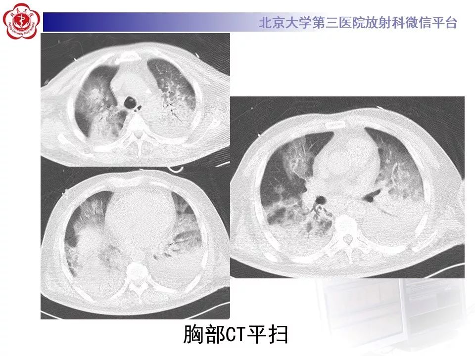 影像PPT - 【PPT】军团菌肺炎的影像-3