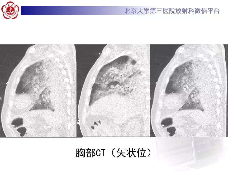 影像PPT - 【PPT】军团菌肺炎的影像-4