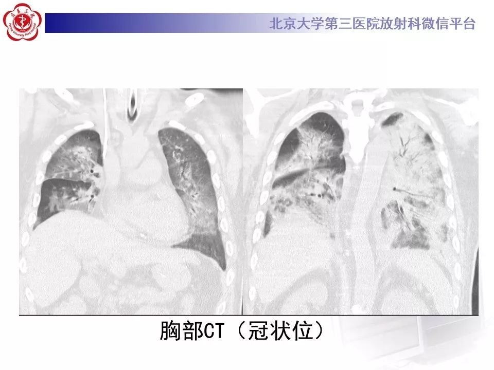 影像PPT - 【PPT】军团菌肺炎的影像-5