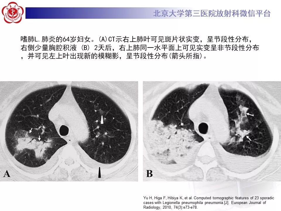 影像PPT - 【PPT】军团菌肺炎的影像-26