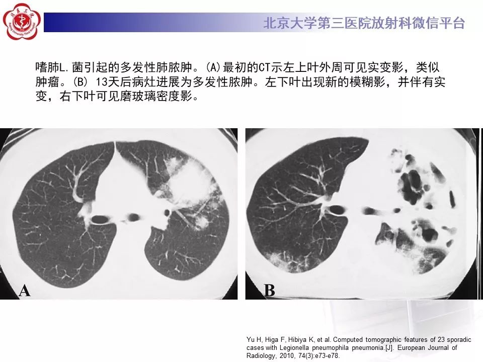 影像PPT - 【PPT】军团菌肺炎的影像-27