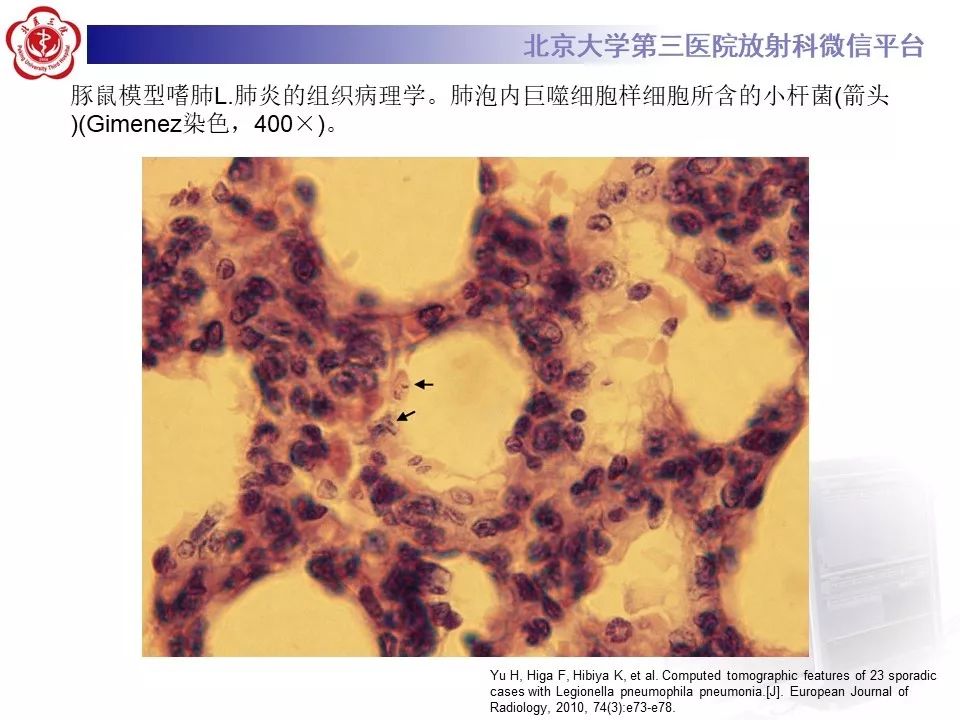 影像PPT - 【PPT】军团菌肺炎的影像-29