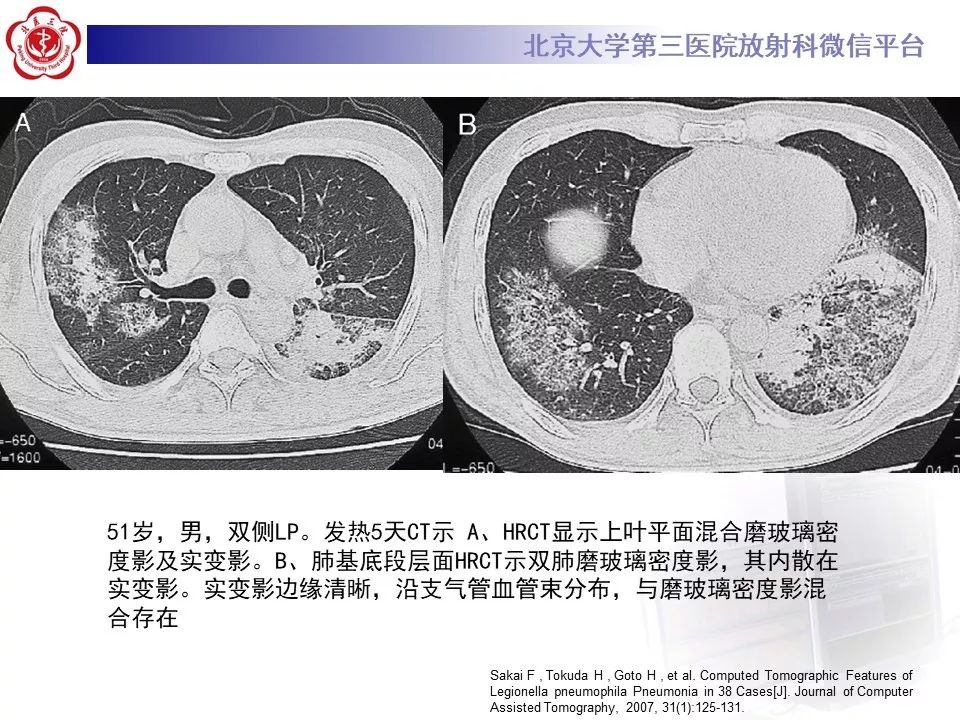 影像PPT - 【PPT】军团菌肺炎的影像-30