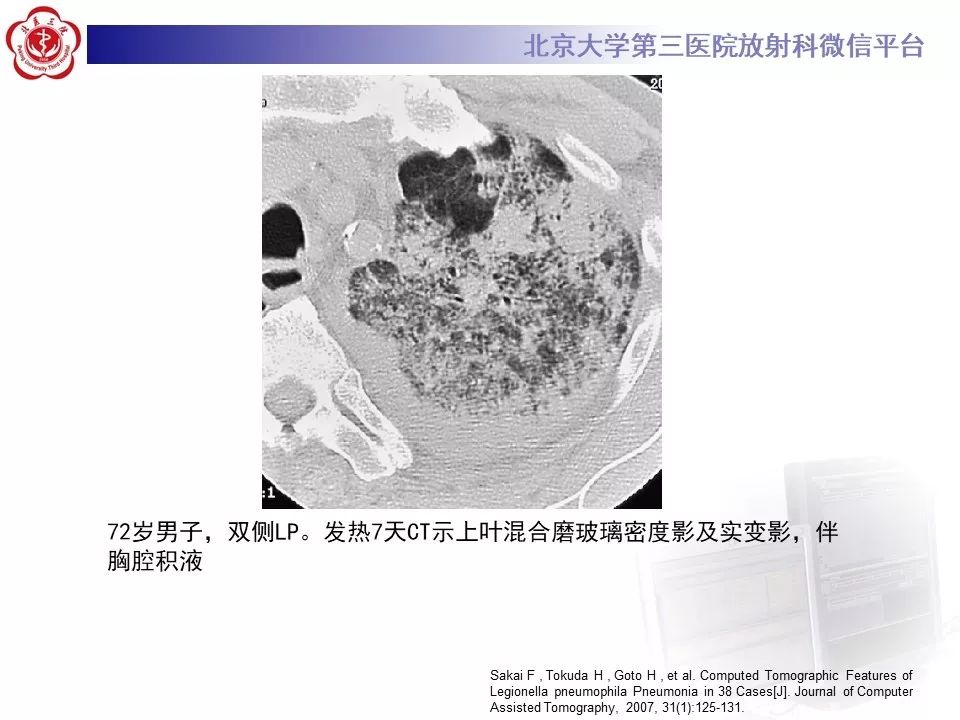 影像PPT - 【PPT】军团菌肺炎的影像-31