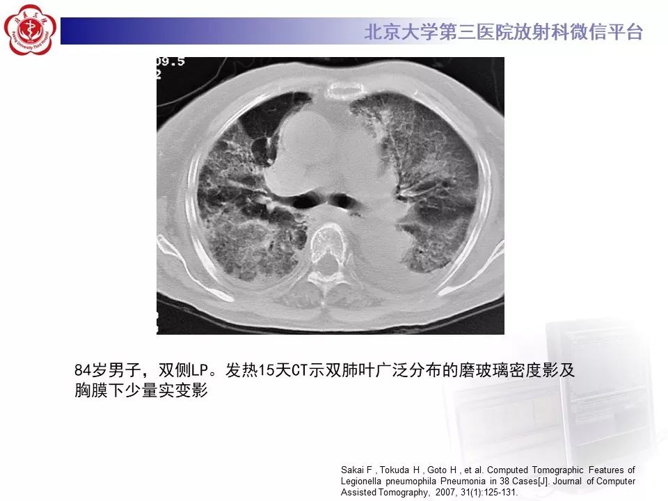 影像PPT - 【PPT】军团菌肺炎的影像-32