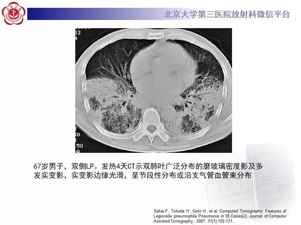 影像PPT - 【PPT】军团菌肺炎的影像-33