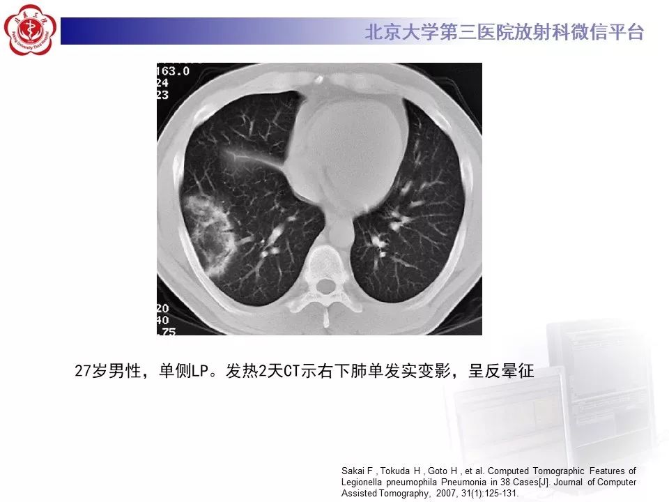 影像PPT - 【PPT】军团菌肺炎的影像-34