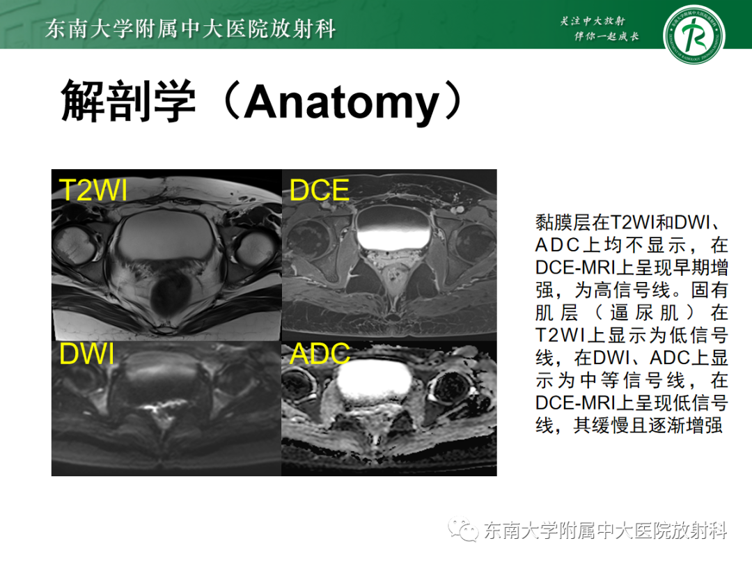 影像PPT - 【PPT】膀胱癌诊断与鉴别诊断-10