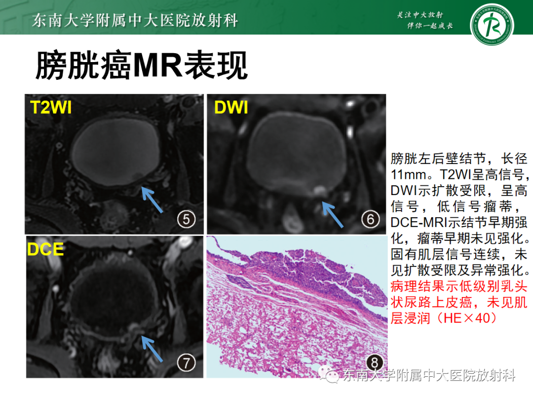 影像PPT - 【PPT】膀胱癌诊断与鉴别诊断-14