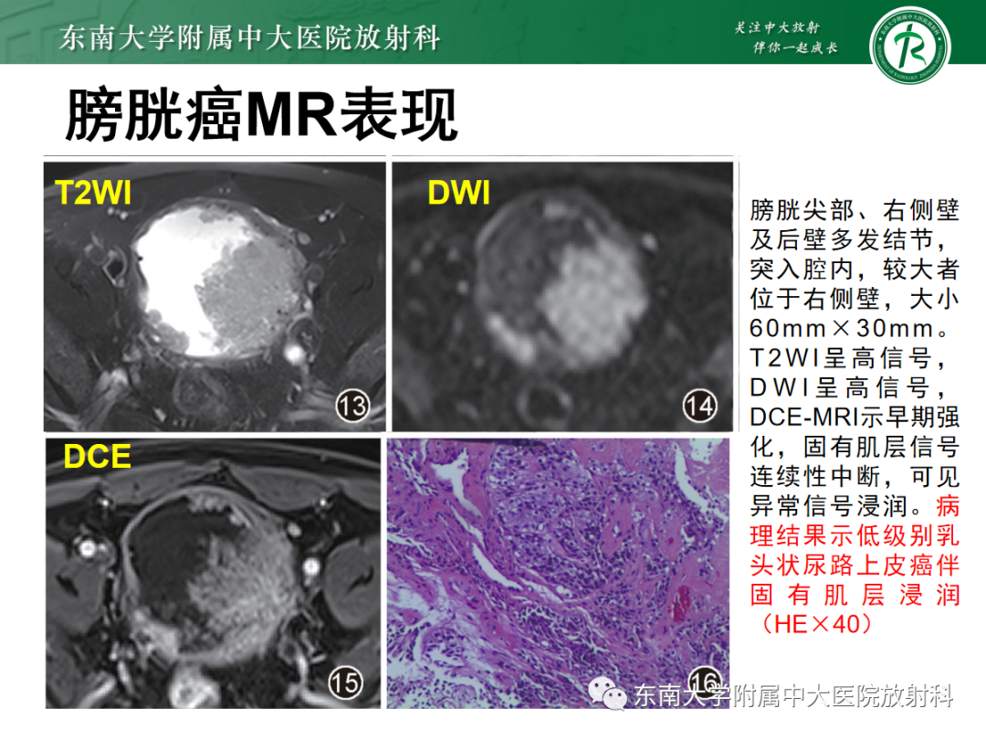 影像PPT - 【PPT】膀胱癌诊断与鉴别诊断-15