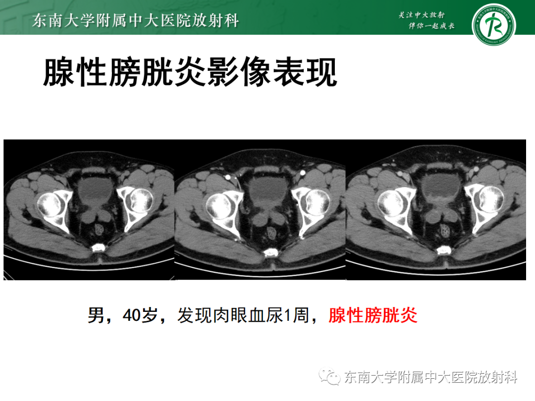 影像PPT - 【PPT】膀胱癌诊断与鉴别诊断-20