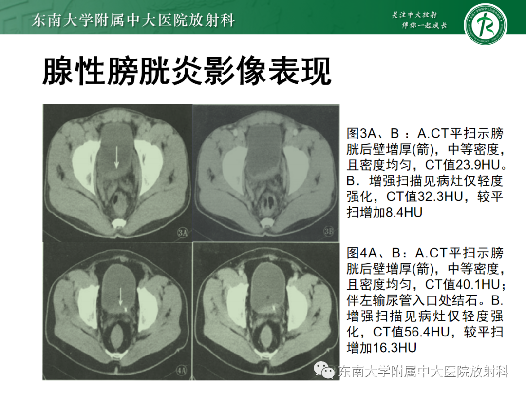 影像PPT - 【PPT】膀胱癌诊断与鉴别诊断-22