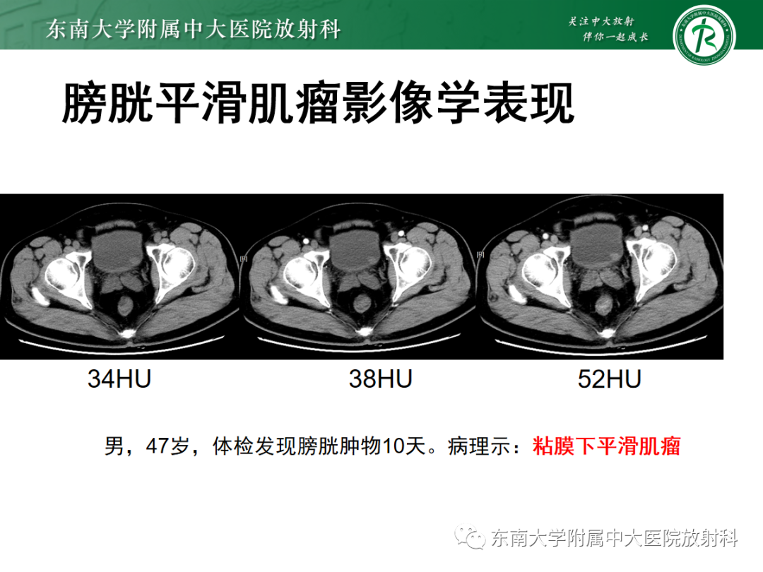 影像PPT - 【PPT】膀胱癌诊断与鉴别诊断-25