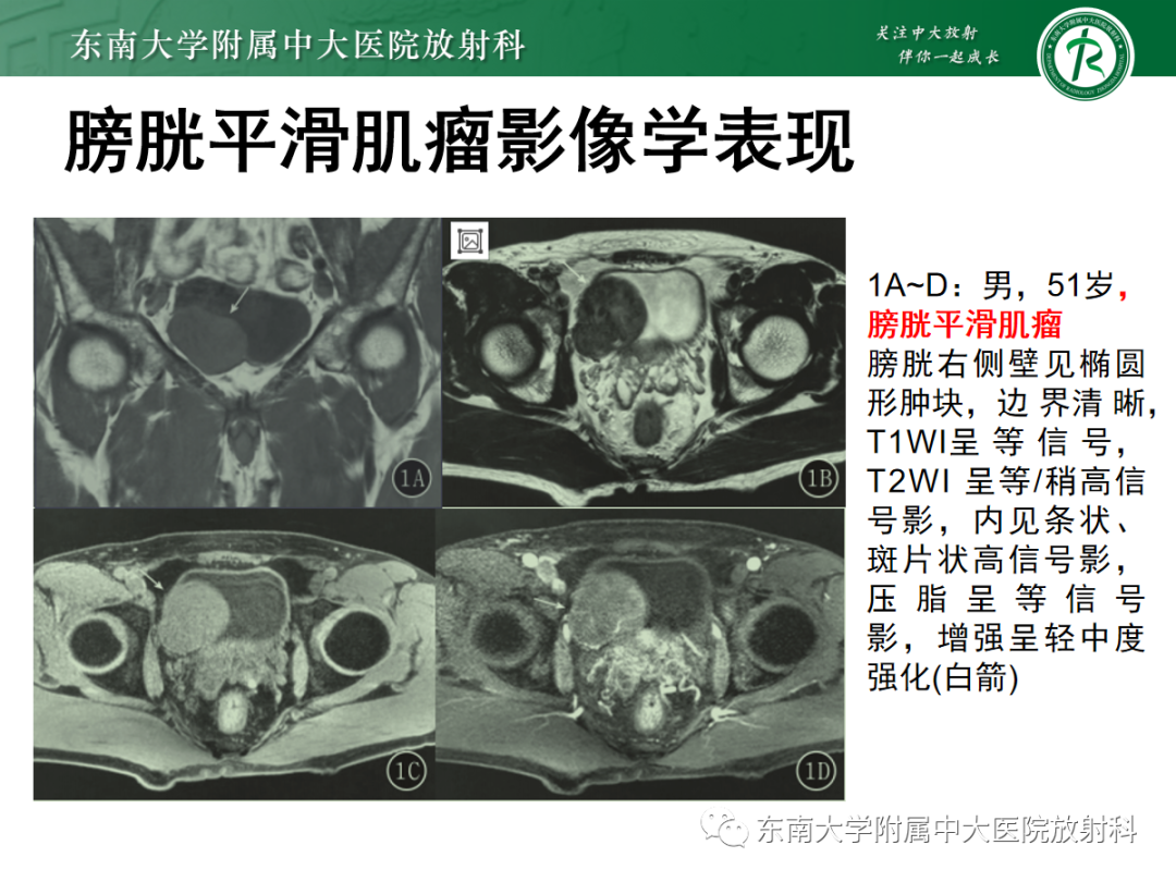 影像PPT - 【PPT】膀胱癌诊断与鉴别诊断-26