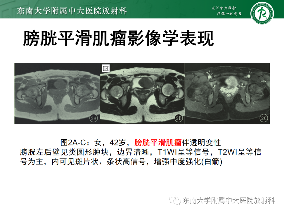 影像PPT - 【PPT】膀胱癌诊断与鉴别诊断-27
