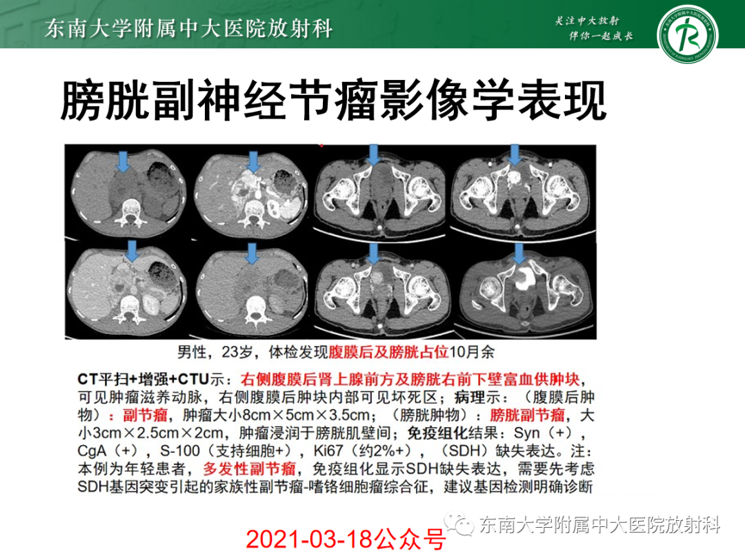 影像PPT - 【PPT】膀胱癌诊断与鉴别诊断-30