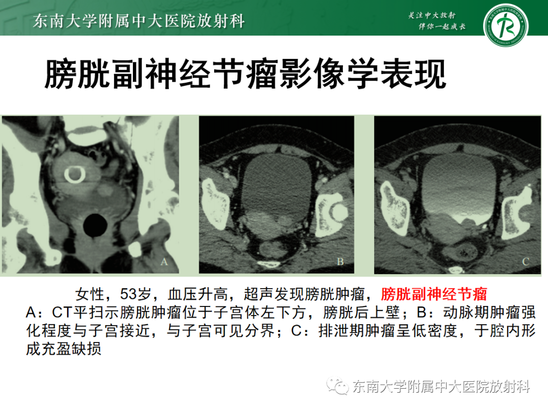 影像PPT - 【PPT】膀胱癌诊断与鉴别诊断-31