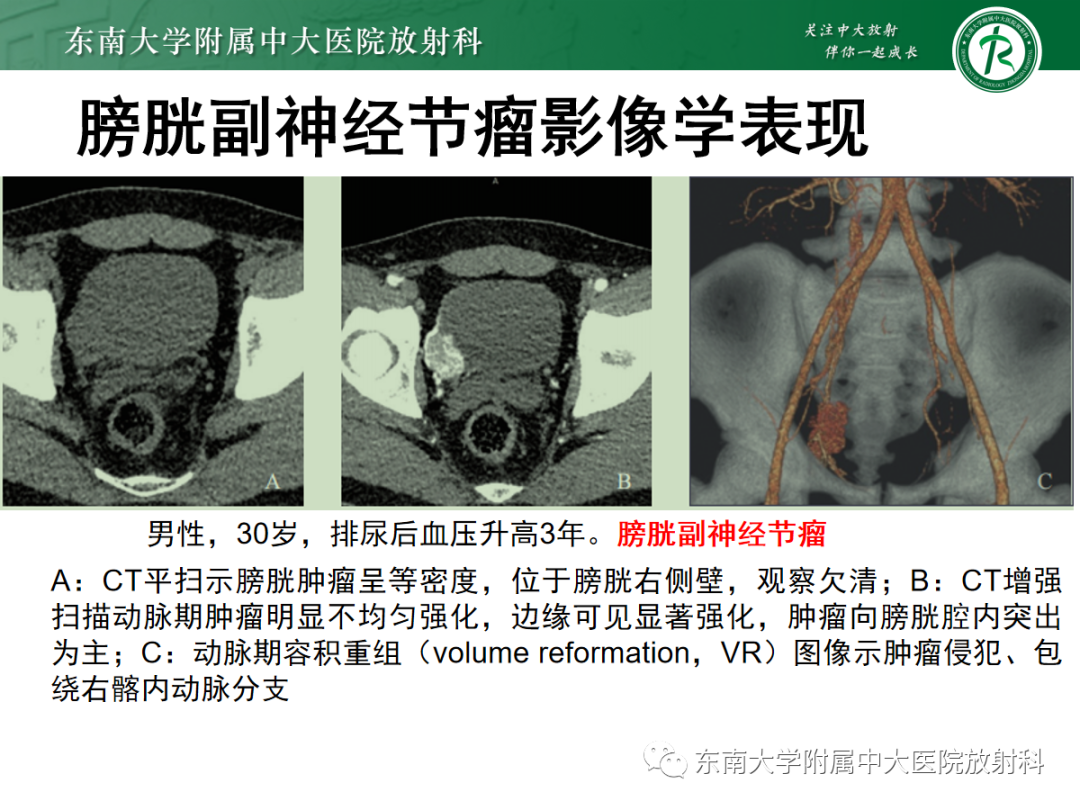 影像PPT - 【PPT】膀胱癌诊断与鉴别诊断-32