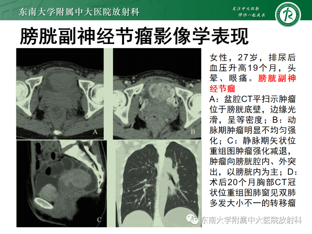 影像PPT - 【PPT】膀胱癌诊断与鉴别诊断-33