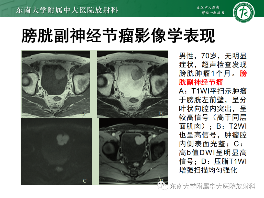 影像PPT - 【PPT】膀胱癌诊断与鉴别诊断-34