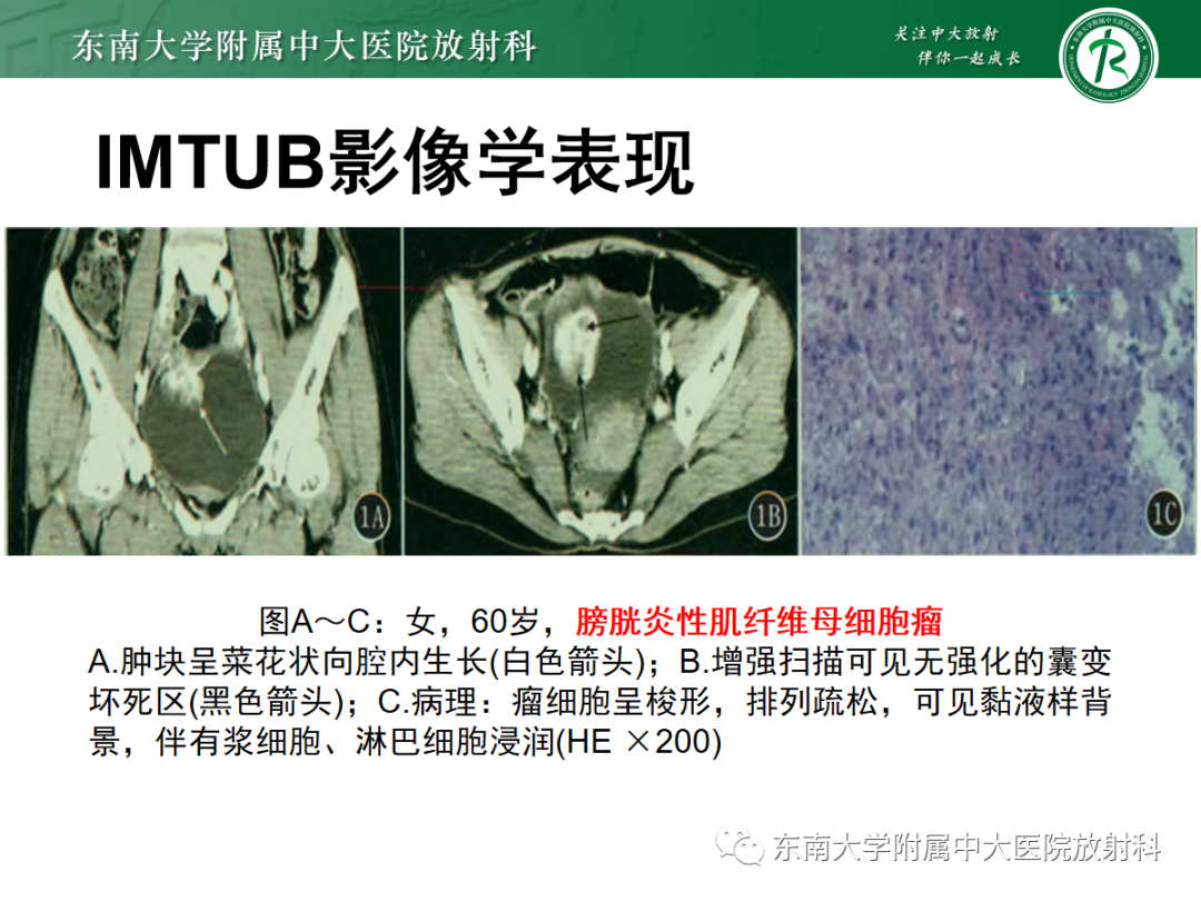 影像PPT - 【PPT】膀胱癌诊断与鉴别诊断-37
