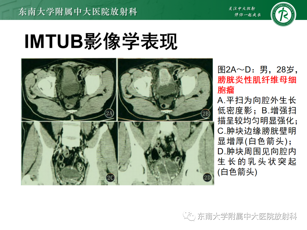 影像PPT - 【PPT】膀胱癌诊断与鉴别诊断-38