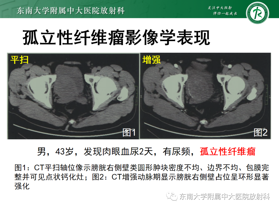 影像PPT - 【PPT】膀胱癌诊断与鉴别诊断-41