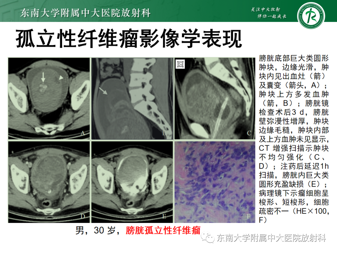 影像PPT - 【PPT】膀胱癌诊断与鉴别诊断-42