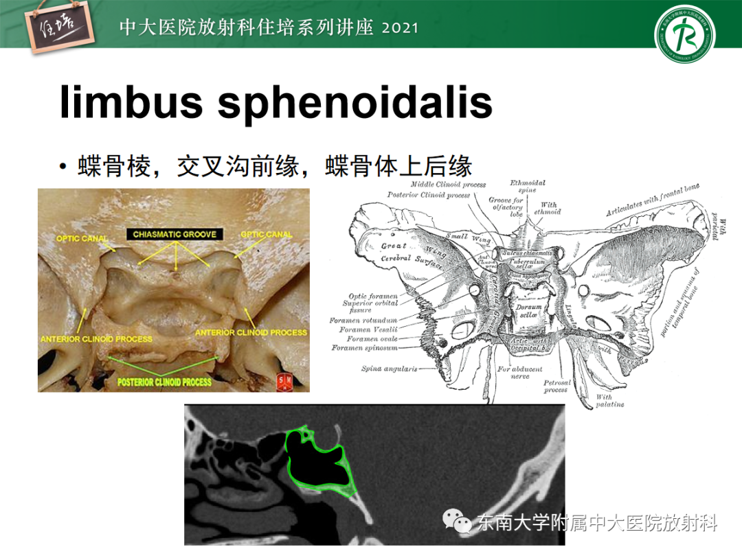 影像PPT - 【PPT】中颅窝底解剖结构及常见骨折征象-3