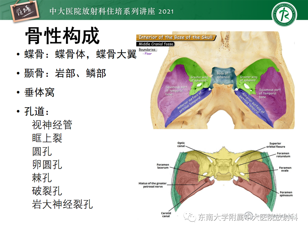 影像PPT - 【PPT】中颅窝底解剖结构及常见骨折征象-5