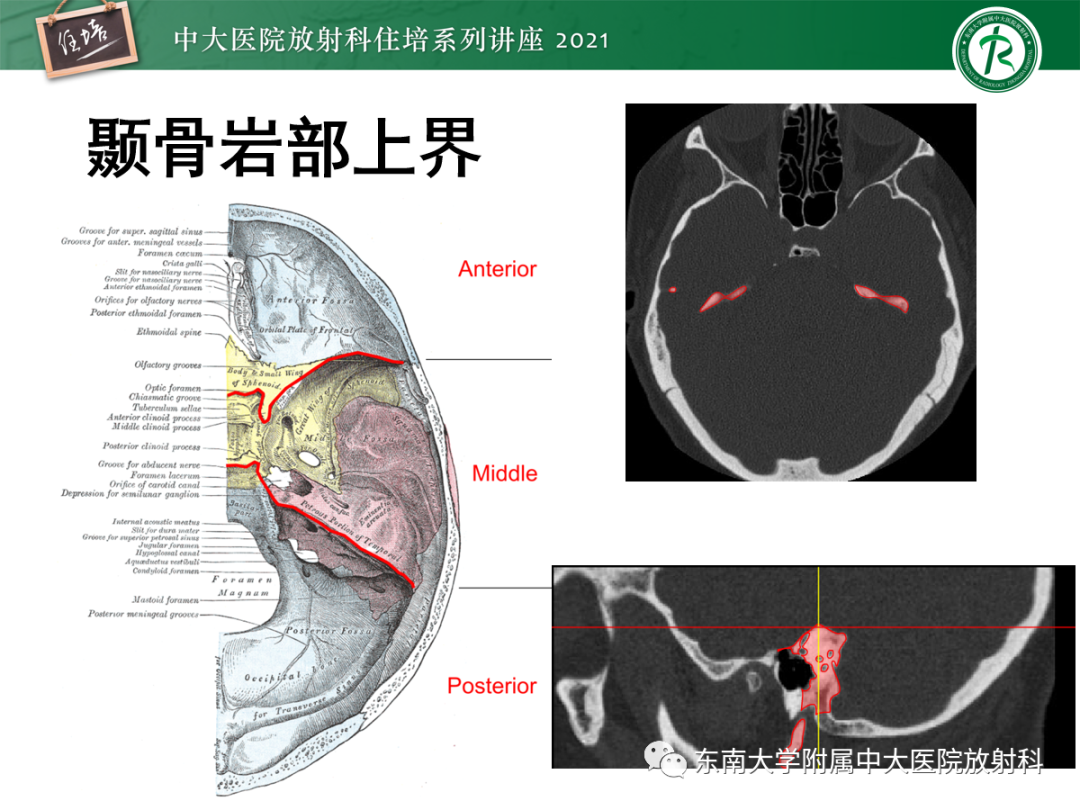 影像PPT - 【PPT】中颅窝底解剖结构及常见骨折征象-4