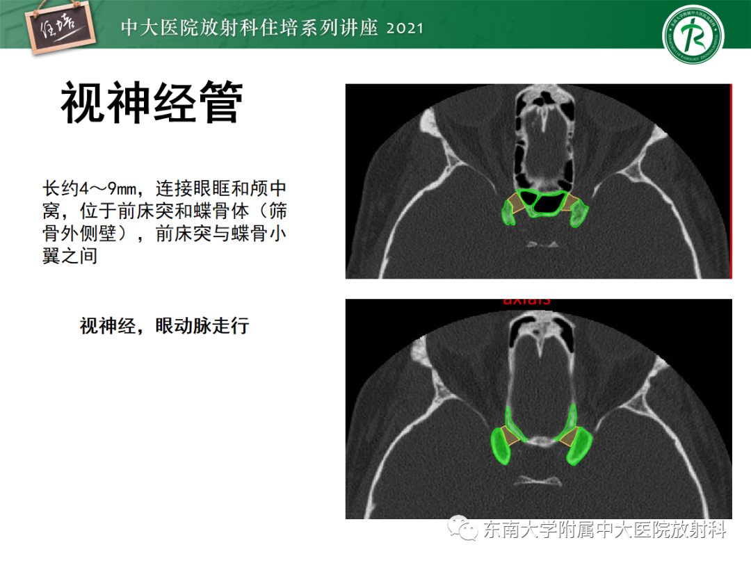 影像PPT - 【PPT】中颅窝底解剖结构及常见骨折征象-7
