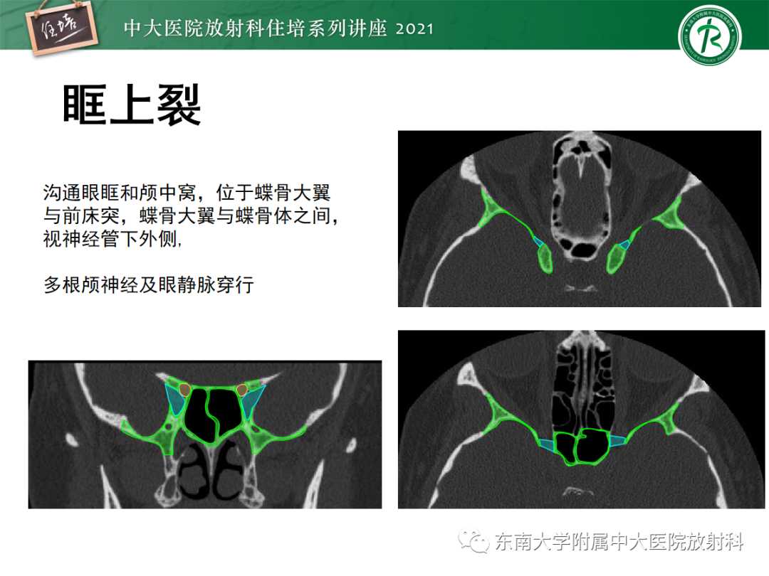 影像PPT - 【PPT】中颅窝底解剖结构及常见骨折征象-8