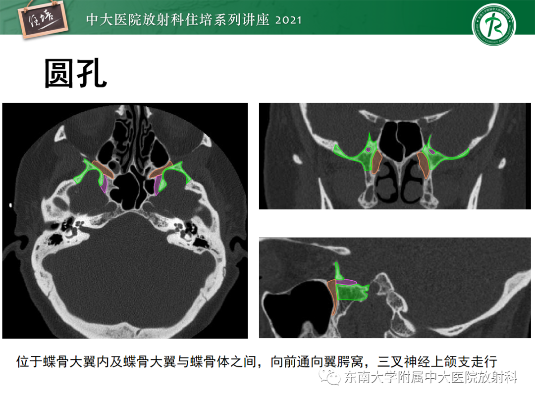 影像PPT - 【PPT】中颅窝底解剖结构及常见骨折征象-9