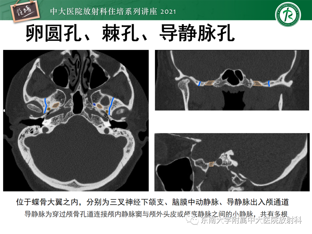 影像PPT - 【PPT】中颅窝底解剖结构及常见骨折征象-10