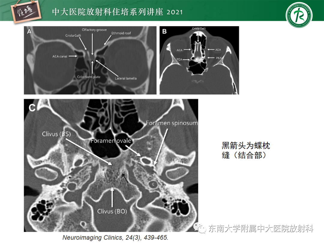 影像PPT - 【PPT】中颅窝底解剖结构及常见骨折征象-13