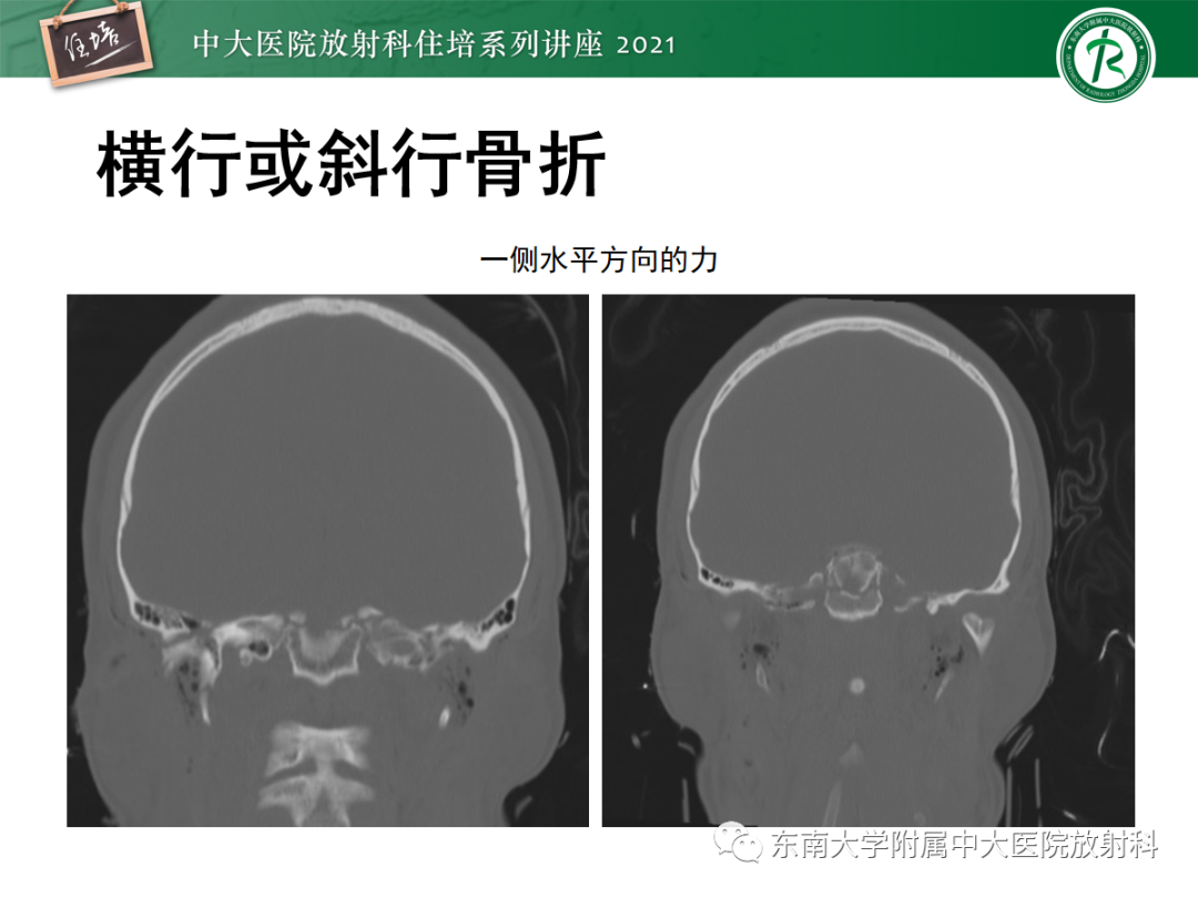 影像PPT - 【PPT】中颅窝底解剖结构及常见骨折征象-16