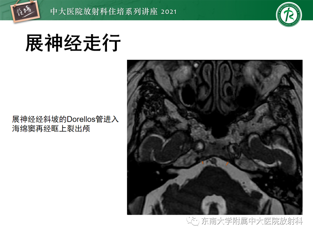 影像PPT - 【PPT】中颅窝底解剖结构及常见骨折征象-18